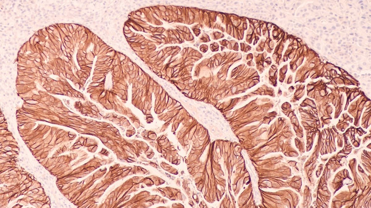 Jazz Pharmaceuticals: The Cancer Drug That Could Equal the Whole ...